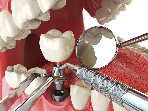Best Chipped Tooth Repair Near Me  in Apple Valley, OH